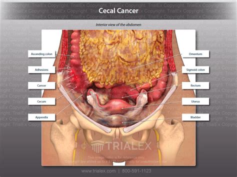 cecal cancer trial exhibits inc