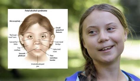 Lengthening the bridge does not affect the epicanthal folds but augmenting the radix at the top of the nose does. Fetal alcohol syndrome "Railrosd track" ears Epicanthal Ne ...