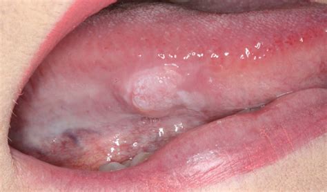 30 Painful White Bump On Side Of Tongue Background