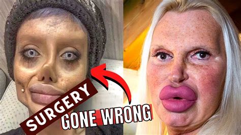 Times Plastic Surgery Went Horribly Wrong Biggest Celebrity