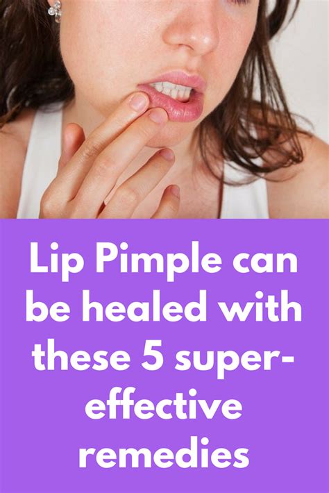 Lip Pimple Can Be Healed With These 5 Super Effective Remedies Pimples Pimples Remedies