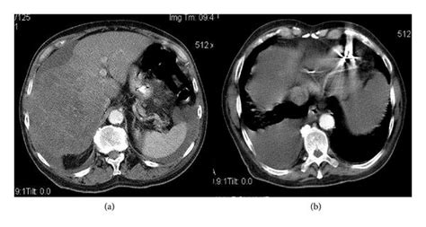 Contrast Enhanced Ct Scan Of Thorax Abdomen And Pelvis Download