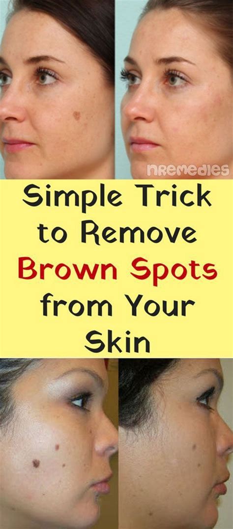 Simple Trick To Remove Brown Spots From Your Skin Spots On Face Brown Spots On Face Brown