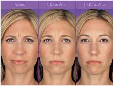 When administering botox injections, it's necessary to keep within certain anatomical margins as the toxin can spread from the point of the injection site to influence surrounding areas. BOTOX Injections - Cost | Candidate