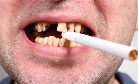 smoking causes gum disease oral cancer and more