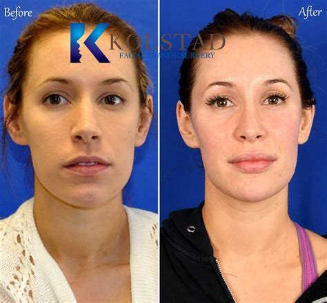 Wide Bridge Nose Job Before And After Gallery 1 Dr Kolstad San Diego