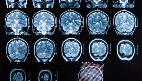 Sclerosi Multipla I Sintomi La Diagnosi Le Cure Dilei