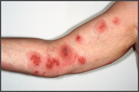 Images Of Shingles On Hands Wash Their Hands Frequently Especially