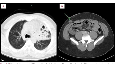Figure 1 From Classical Presentation Of Disseminated Blastomycosis In A