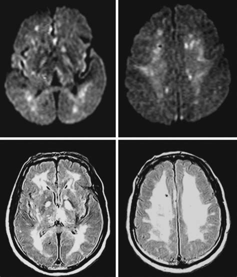 90 Amazing Can You See Anoxic Brain Injury On Mri Insectza