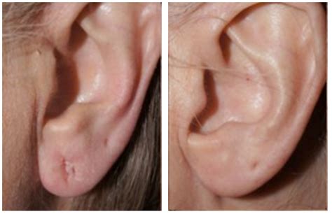 Earlobe Reconstruction Gallery Beverly Hills Plastic Surgeon Dr