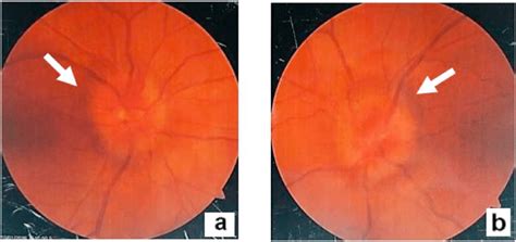 Funduscopic Examination Showed Bilateral Optic Disc Swelling Arrow