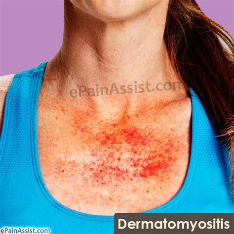 Dermatomyositis Read Skindermatomyositis