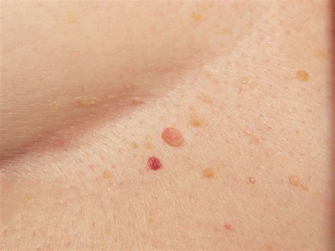 The sooner a skin cancer is identified and treated, the better your chance of avoiding surgery or, in the case of a serious melanoma or other skin cancer, potential disfigurement or even death. 20 Skin Cancer Symptoms Everyone Needs to Know | Best Life
