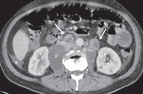 Scielo Brasil Abdominal Tuberculosis A Radiological Review With