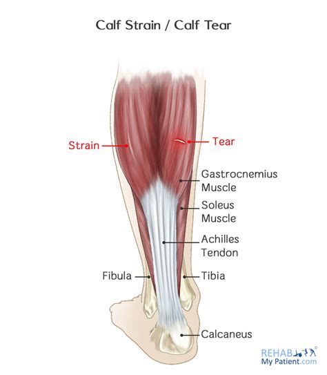 The muscles in the medial compartment adduct the thigh. Calf Strain / Calf Tear | Rehab My Patient