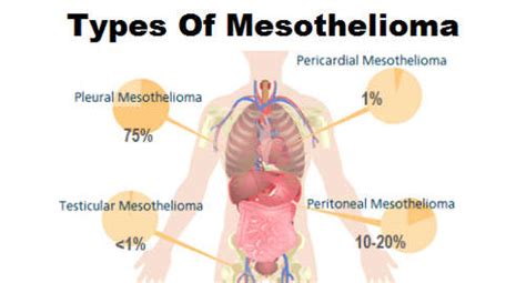 Maybe you would like to learn more about one of these? HealthoolWhat is Mesothelioma - Symptoms, Causes ...
