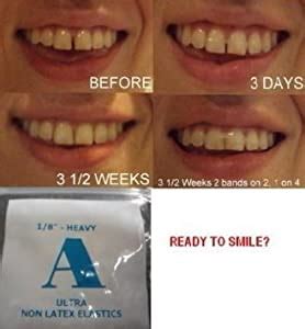 You then wear the bands as needed in order to keep the gap closed. Amazon.com : ORTHODONTIC ELASTIC GAP TEETH BANDS - SIZE 1 ...