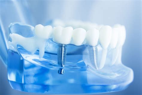 Best Dental Implants In Fredericksburg Va Spotsylvania Oral Surgery