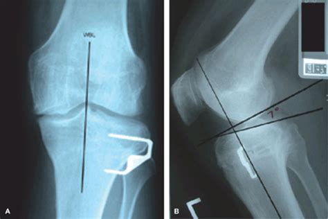 High Tibial Osteotomy Musculoskeletal Key