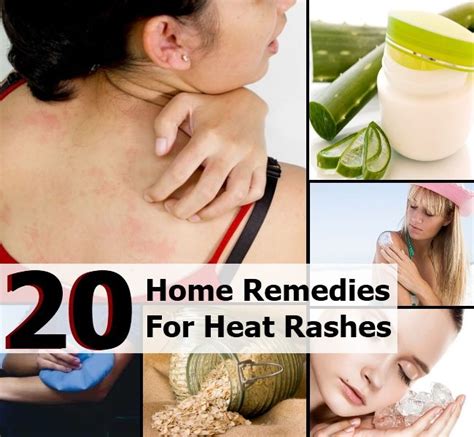 20 Best Home Remedies For Heat Rashes Diy Home Things Heat Rash Home Remedies Remedies