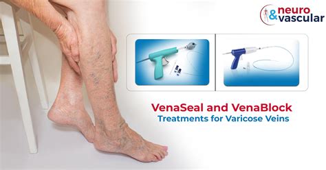 Vena Block And Venaseal Treatments For Varicose Veins