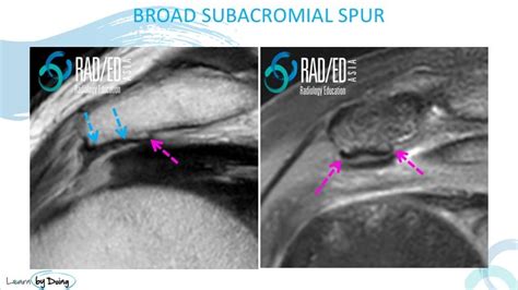 Acromion Acromial Spurs On Mri Where To Look And What To Look For