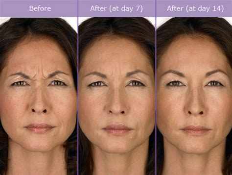 Botox Treatment Before After Transform Me Med Spa