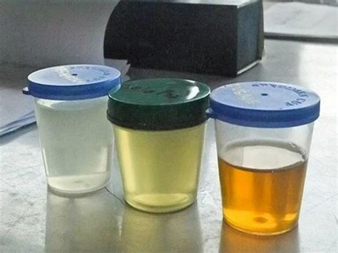 Urine Color Can Determine A Persons Health Status