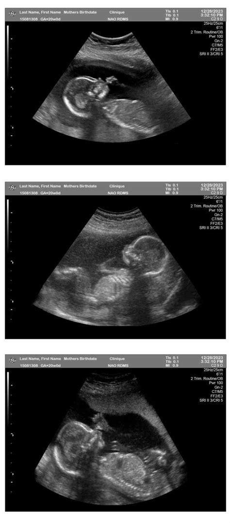 20 Week Pregnancy Ultrasound Ultrasounds