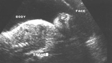 Exencephaly Anencephaly Sequence And Its Sonographic Features