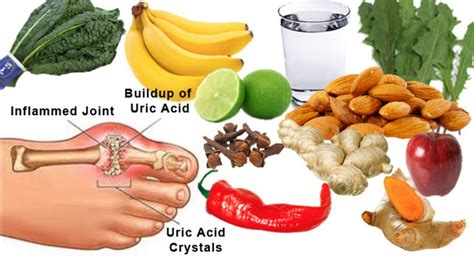 Gout Treatment How To Cure Gout Fast At Home With Natural Remedies