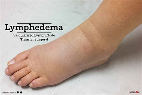 Lymphedema Vascularized Lymph Node Transfer Surgery By Dr
