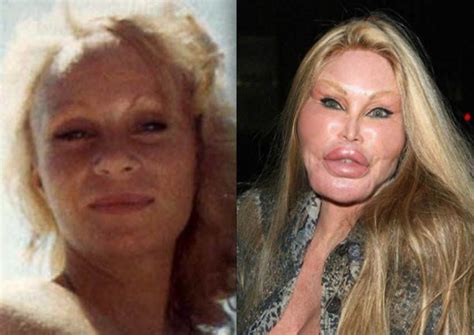 Top 10 Worst Celebrity Plastic Surgery Disasters 2013 2014 Bad Celebrity Plastic Surgery