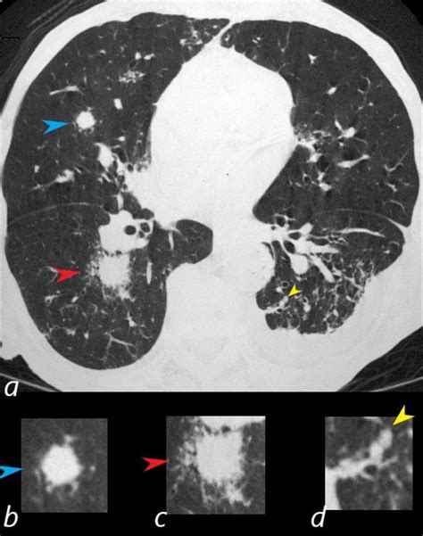 Wegeners Granulomatosis With Polyangiitis Gpa Lungs