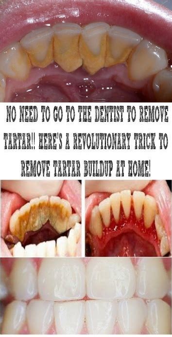 no need to go to the dentist to remove tartar here s a revolutionary trick to remove tartar