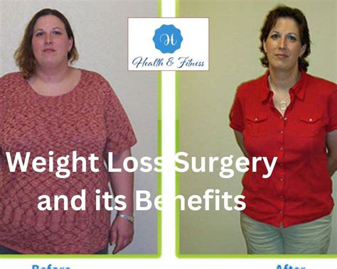 Weight Loss Surgery Uk Transform Your Life