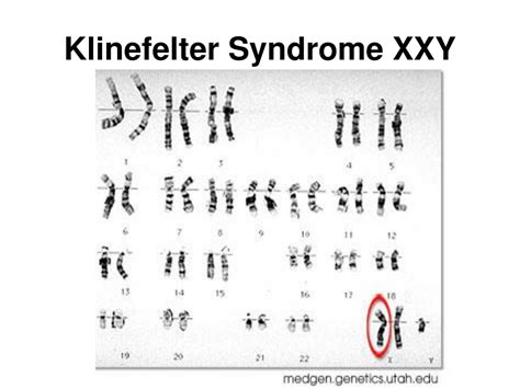 Ppt Karyotypes And Chromosomal Disorders Powerpoint Presentation Id
