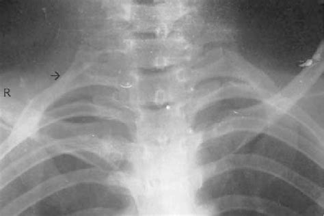 Pa View Of Chest X Ray Showing A Well Formed Rightsided Cervical Rib
