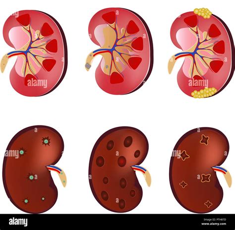 3d Realistic Anatomy Vector Set Kidney Normal Kidney Kidney Infection