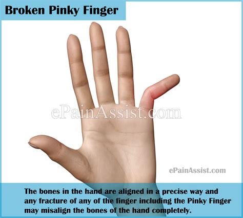 broken pinky finger causes symptoms treatment recovery