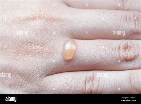 Blister Skin Hi Res Stock Photography And Images Alamy
