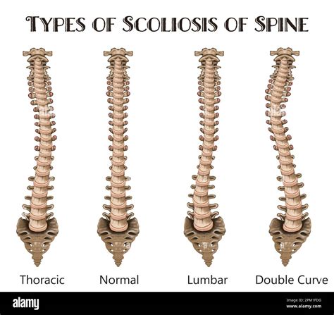 Scoliosis Types