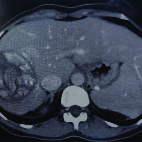 Ce3a Hydatid Cyst In Right Liver Lobe Shown In Abdominal Ct Scan 3