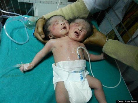 very very rare conjoined twins born in india pictures huffpost uk news