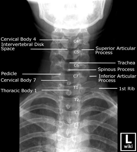 Cervical Spine Radiographic Anatomy Radiologypicscom Cervical