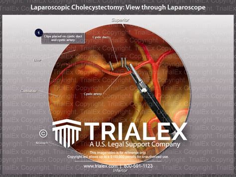 Laparoscopic Cholecystectomy Trial Exhibits Inc