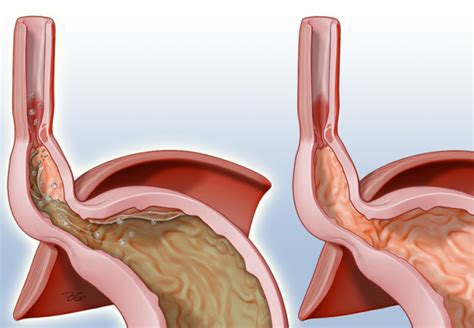 Hiatal Paraesophageal Hernia New Hernia Technology Medcraze