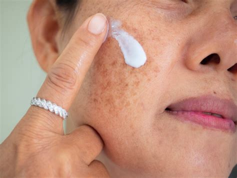 Sun Spots On Skin Vs Age Spots Scary Symptoms