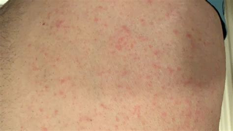 Skin Rash Please Advise People Dermatitis And Eczema Forums Patient